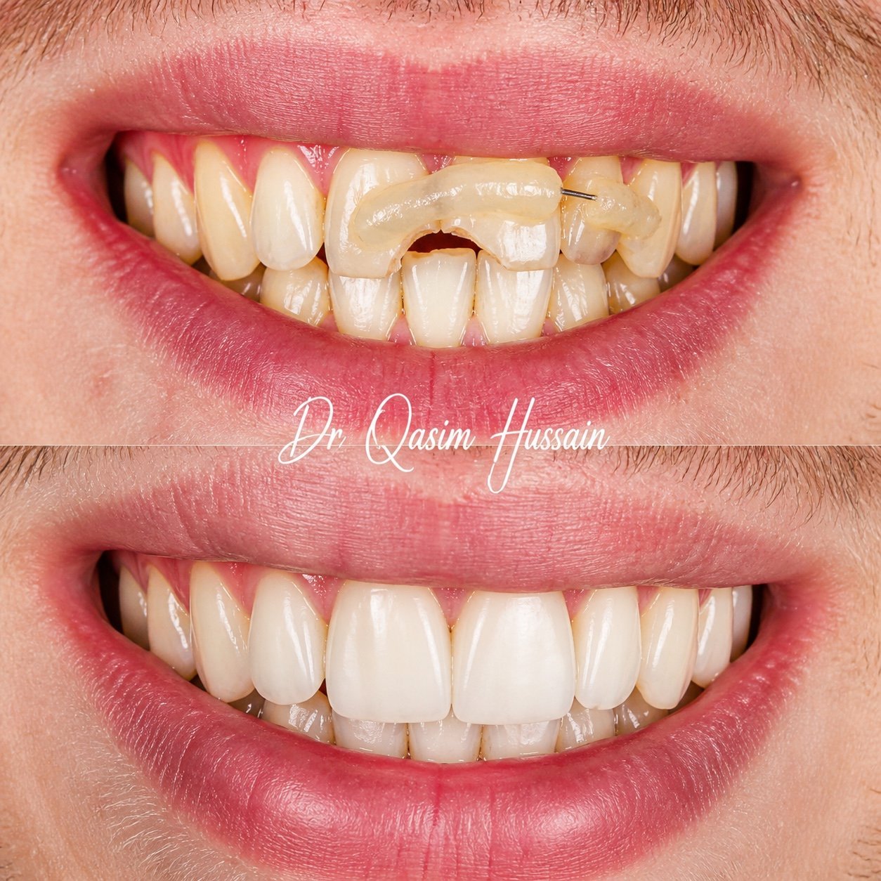 Smile Transformation Before and After